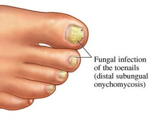 Dermatophytic Onychomycosis Market'