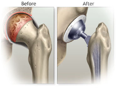 Artificial Joints Market Opportunity Analysis : 2017-2023
