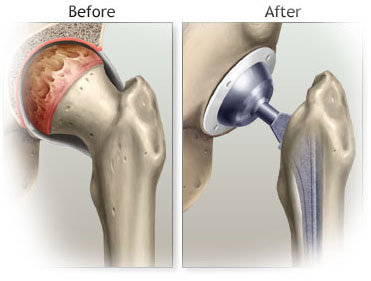 Artificial Joints Market Opportunity Analysis : 2017-2023'