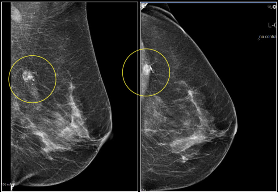 Mammography Market