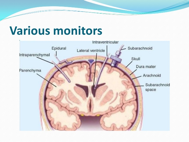 Intra-Cranial Pressure Monitors'
