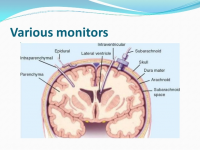 Intra-Cranial Pressure Monitors