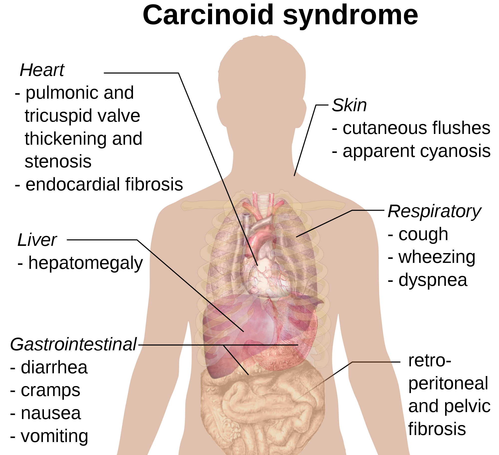 Serotonin Syndrome Market'