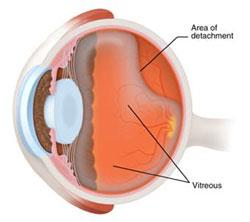 Retinal detachment Market'