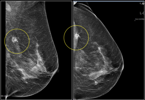 Mammography Market'