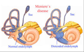 Meniere&rsquo;s disease market