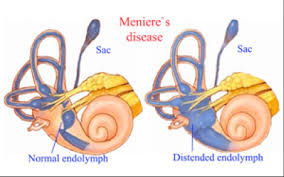 Meniere&rsquo;s disease market'