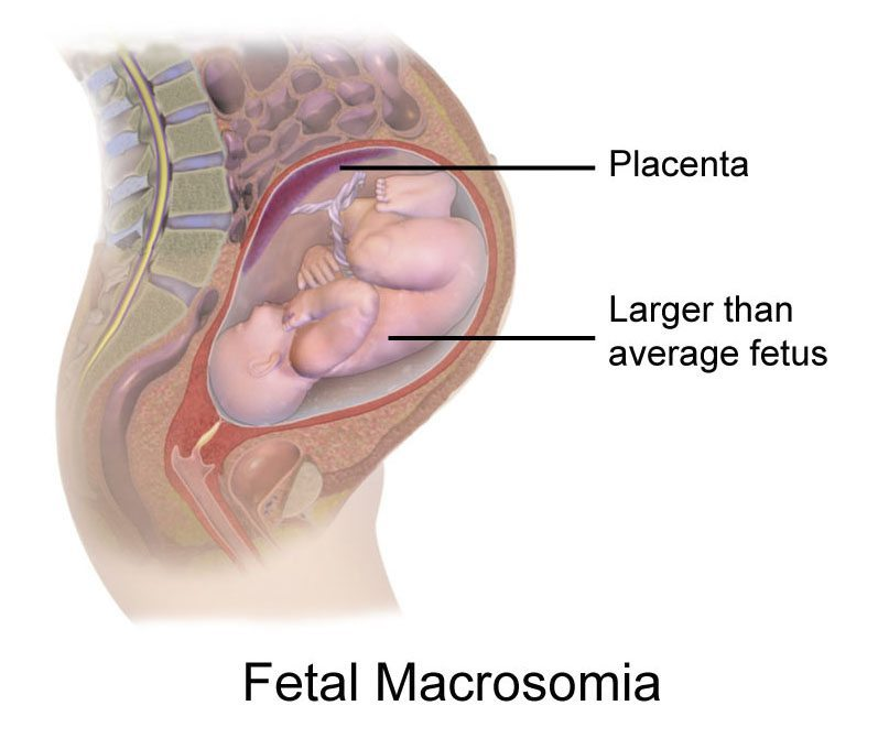 Fetal macrosomia market