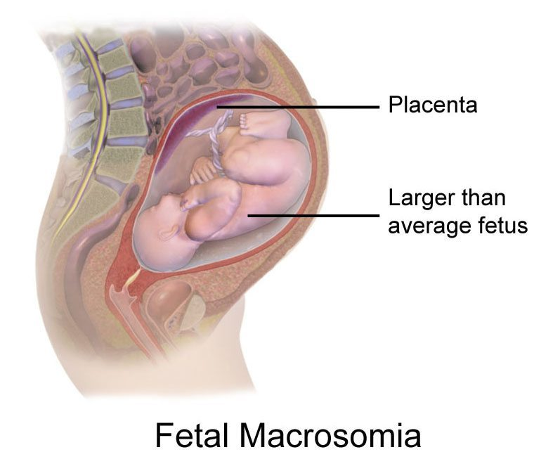 Fetal macrosomia market'