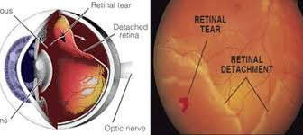 Retinal detachment Market'