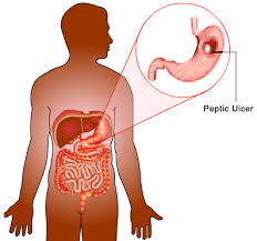 Peptic Ulcer Drugs'