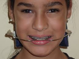 Orthodontic Headgear'