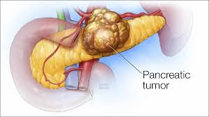 Pancreatic Tumor