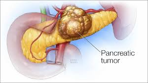 Pancreatic Tumor'