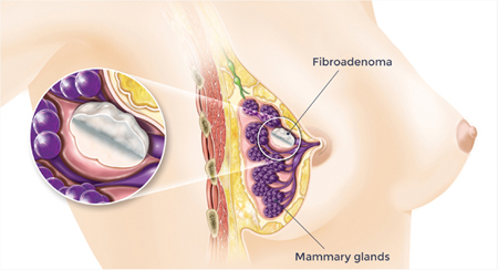 Fibroadenoma Market