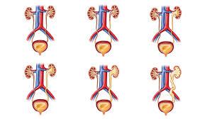 Vesicoureteral Reflux Market