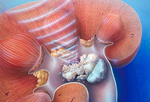 Kidney Stones  Market'