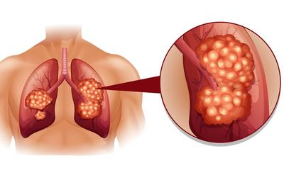 Lung Cancer Market'