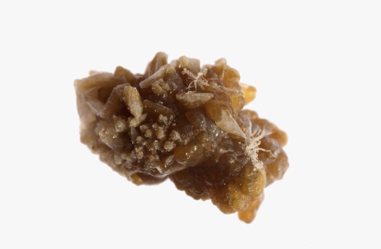 Kidney Stones Market'