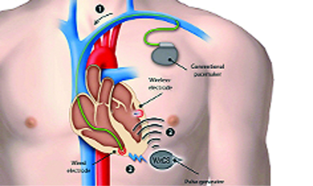 Cardiac Pacemaker Market'