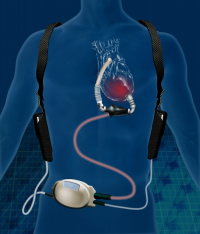 Cardiac Assist Devices market