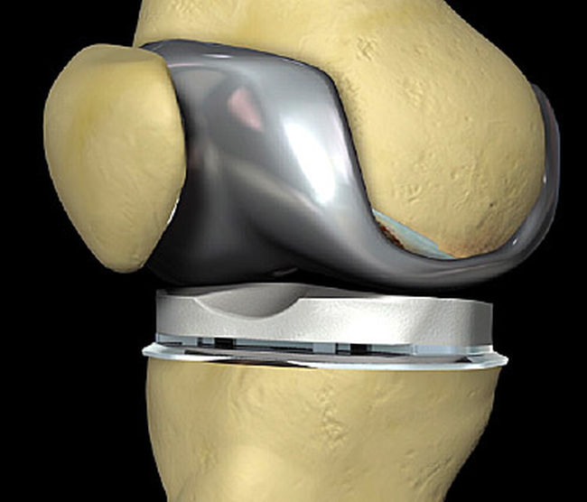 Knee replacement Market'