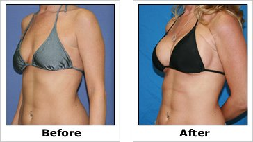 Breast Augmentation'
