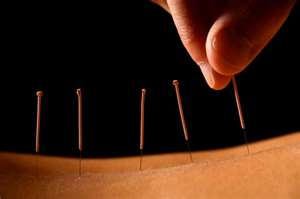 Pain Relief with Acupuncture'