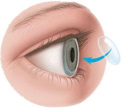 Corneal Transplant Market