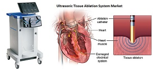 Ultrasonic Tissue Ablation System Market Players, Product,An'