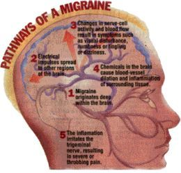 Migraine Drugs Market Opportunity Analysis : 2017-2023'