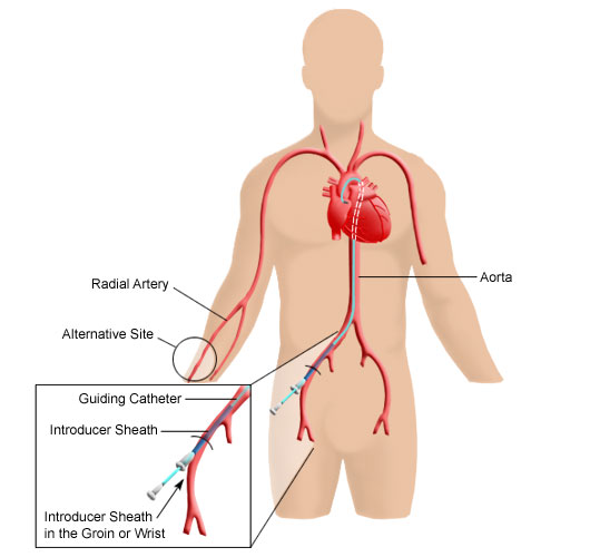 Cardiac Catheters Market : Competitive Developments, Leading