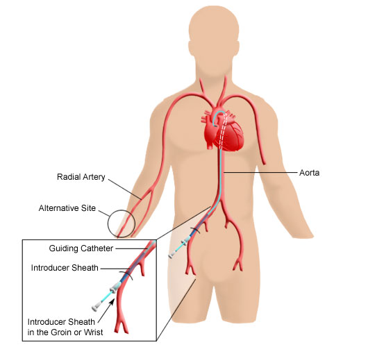 Cardiac Catheters Market : Competitive Developments, Leading'