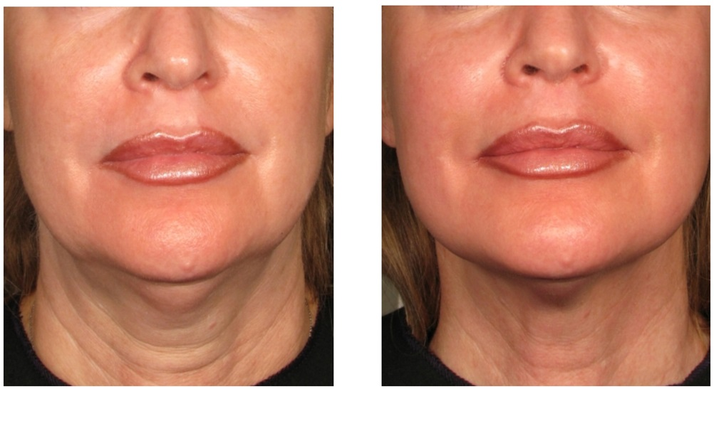 High Intensity Focused Ultrasound Therapy Harket