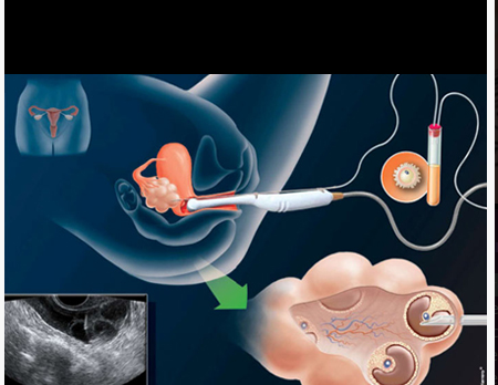 in vitro fertilization (IVF) services'