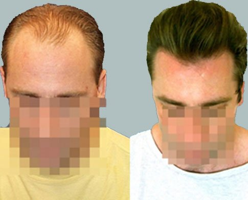 The Cole Hair Transplant Group'