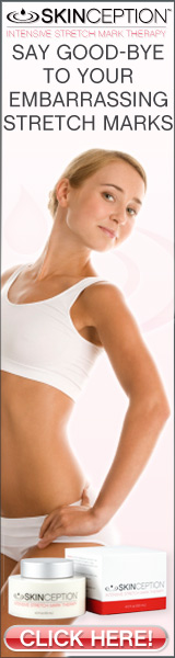 how to get rid of stretch marks'