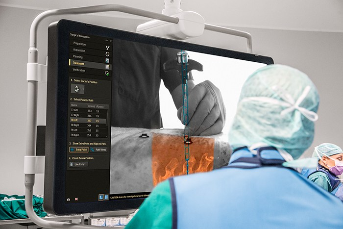 Global Intra-Operative 3D Navigation Market