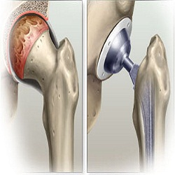 Bone Replacement Market is Set to Change the Face of Healthc