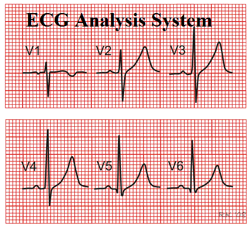 Electrocardiography Analysis System market