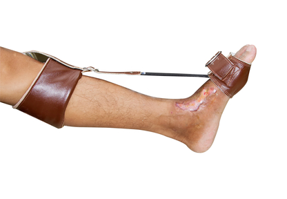 Foot Drop Implants Market by Key Players, Product,Analysis a'