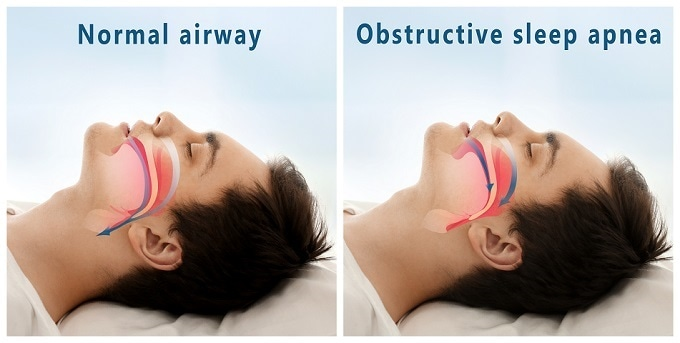 Obstructive Sleep Apnea Therapeutic Device Market'