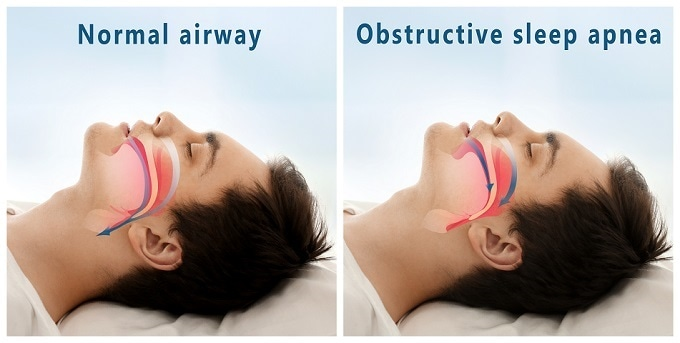 Obstructive Sleep Apnea Therapeutic Device Market