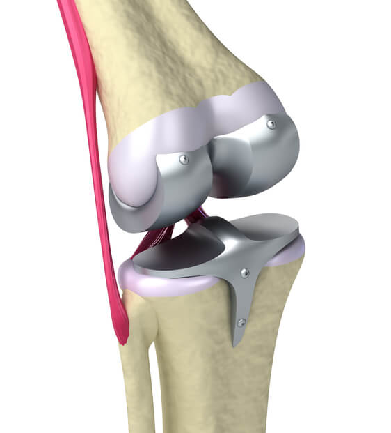 Knee Replacement Devices Market'