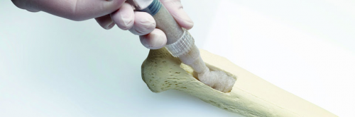 Bone Grafts and Substitutes Market by Key Players, Product,A'