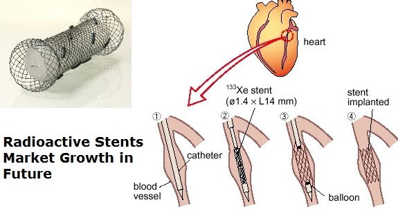 Radioactive Stents Market