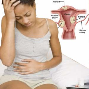 The Best Treatment for Uterine Fibrosis'