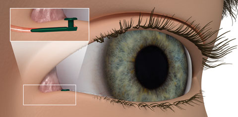 Glaucoma Therapeutics Market Market'