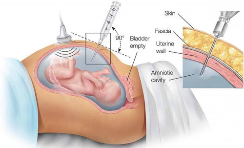 Global Amniocentesis Needle Market'