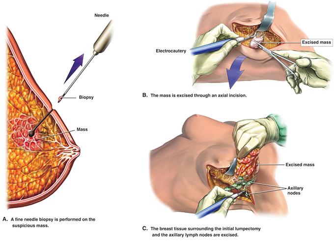 Global And China Lymph Node Dissection Market by Product Val